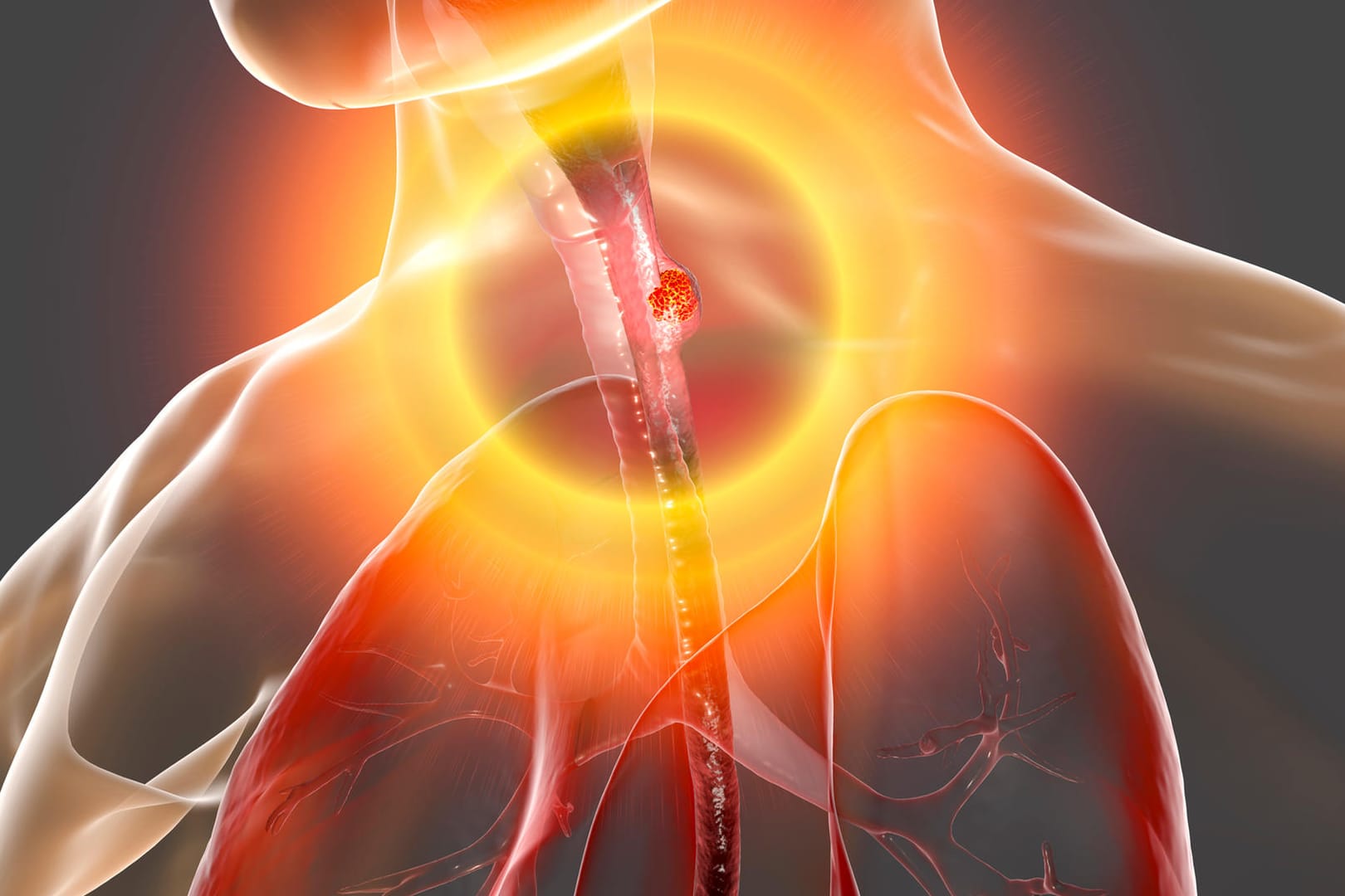 3-D-Aufnahme der Speiseröhre mit einem Tumor: Speiseröhrenkrebs gehör zu den seltenen Krebsarten. 3-D-Aufnahme der Speiseröhre mit einem Tumor: Speiseröhrenkrebs gehör zu den seltenen Krebsarten.