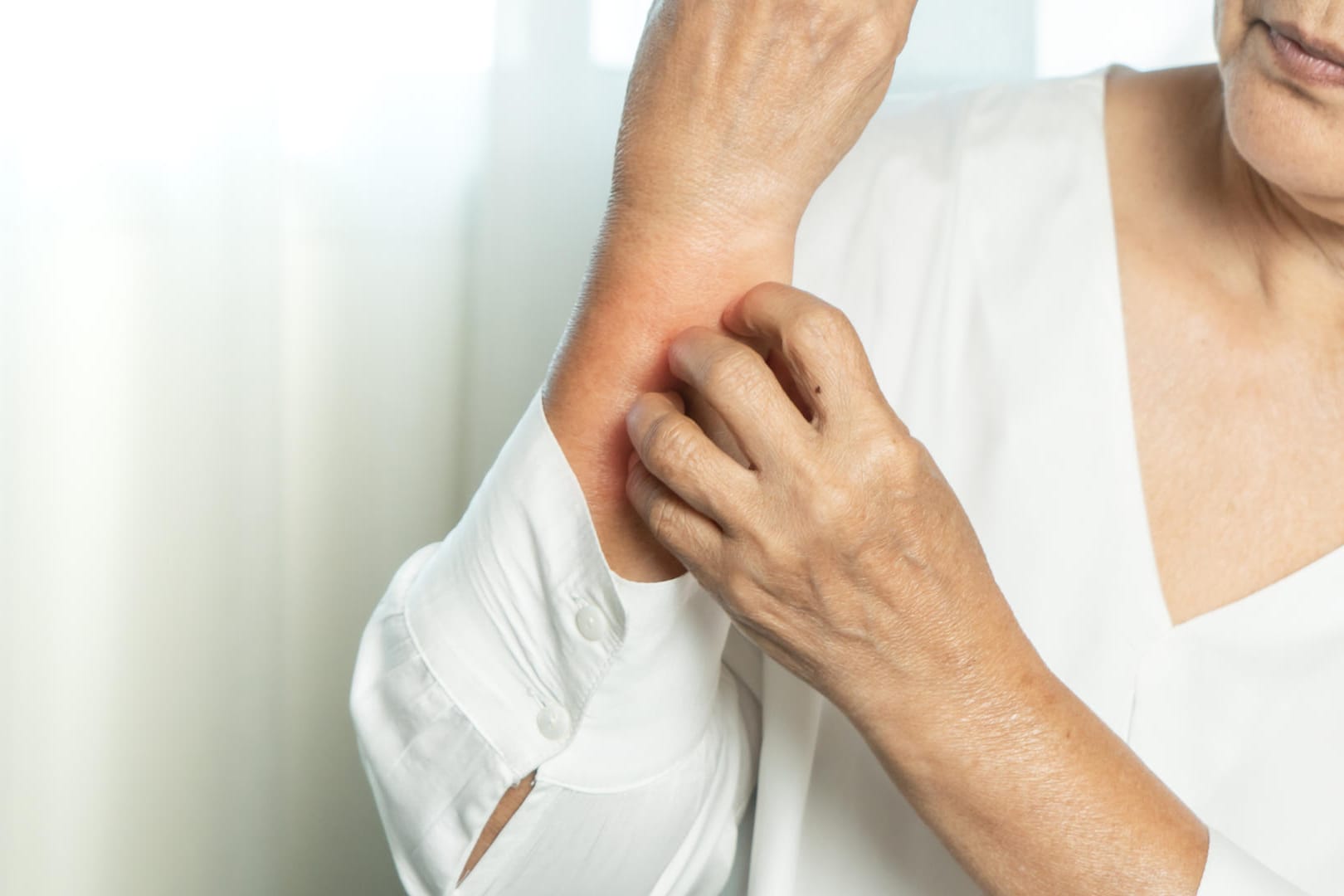 Eine Frau kratzt sich am Arm: Eine Nesselsucht geht meist mit starkem Juckreiz einher. Eine Frau kratzt sich am Arm: Eine Nesselsucht geht meist mit starkem Juckreiz einher.