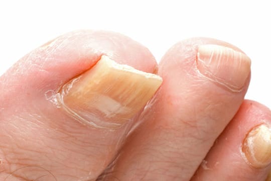 Ein verdickter und verfärbter Fußnagel weist auf Nagelpilz hin. Ein verdickter und verfärbter Fußnagel weist auf Nagelpilz hin.