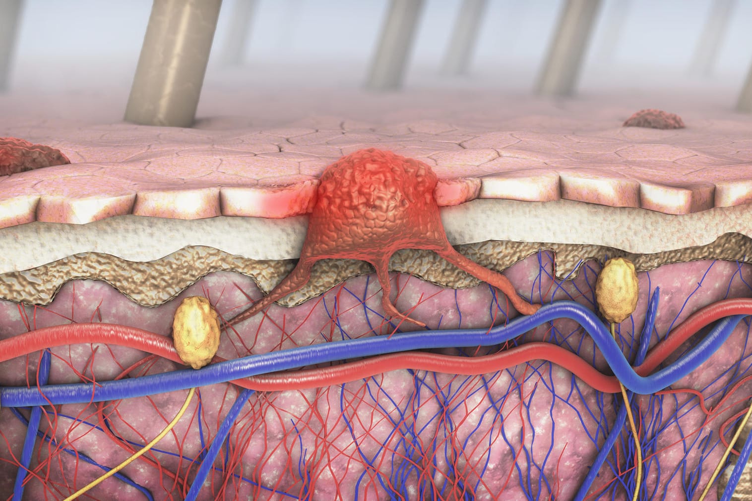 Malignes Melanom: Der Tumor verbindet sich mit den Blut- und Lymphbahnen. Malignes Melanom: Der Tumor verbindet sich mit den Blut- und Lymphbahnen.