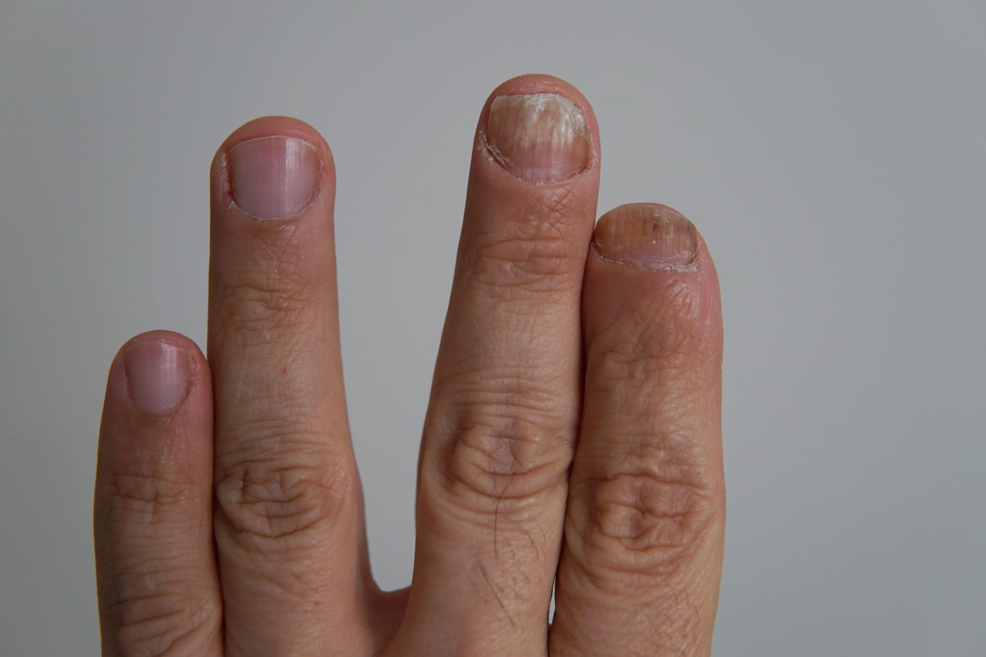 Hand mit Nagelpilz an den Fingernägeln. Hand mit Nagelpilz an den Fingernägeln.