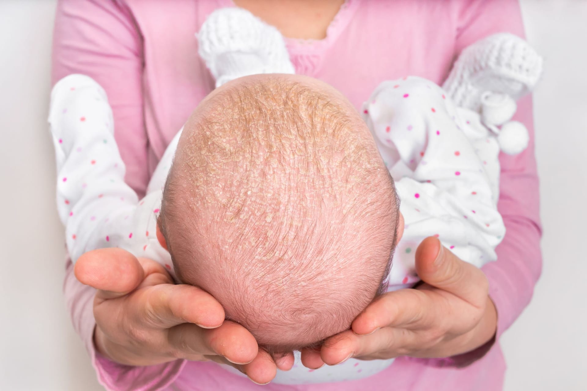 Milchschorf auf dem Kopf von Säuglingen ist harmlos und verschwindet meist schnell wieder. Manchmal aber kann er auch ein Hinweis auf eine beginnende Neurodermitis sein. Milchschorf auf dem Kopf von Säuglingen ist harmlos und verschwindet meist schnell wieder. Manchmal aber kann er auch ein Hinweis auf eine beginnende Neurodermitis sein.