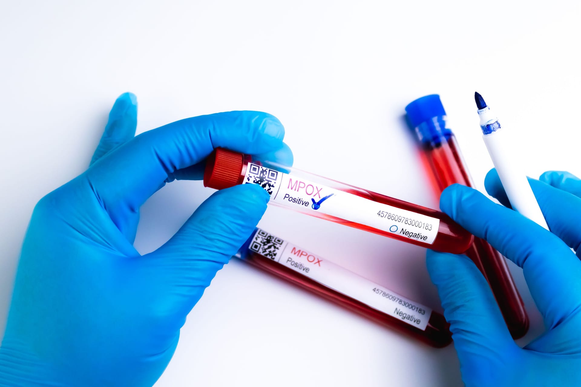WHO hat schon 2022 eine Mpox-Notlage erklärt: Auch in Deutschland gab es Fälle der Erkrankung. WHO hat schon 2022 eine Mpox-Notlage erklärt: Auch in Deutschland gab es Fälle der Erkrankung.